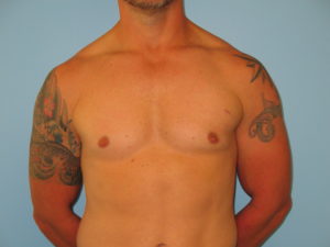 Patient 7 After Gynecomastia Front View