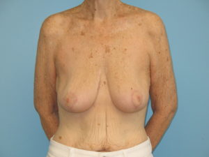 Patient 21 After Breast Reduction Front View