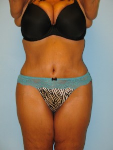 Patient 2 Before Tummy Tuck Front View