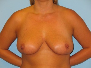 Patient 3 After Breast Reduction Front View