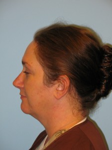 Patient 2 Before Rhinoplasty Left View