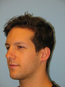 Patient 4 After Otoplasty Left Side Copy