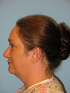 Patient 2 After Rhinoplasty Left View