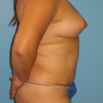 Patient 8 After Abdominoplasty Right Side View