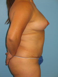 Patient 8 After Abdominoplasty Right Side View