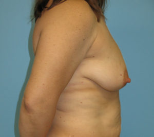 Patient 22 Before Breast Reduction Right View