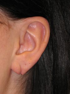 Patient 1 Before Otoplasty