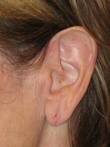 Patient 3 After Otoplasty