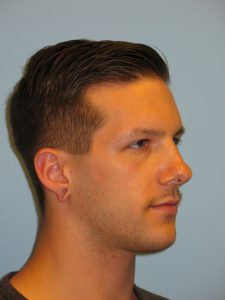 Patient 4 Before Otoplasty Right Side