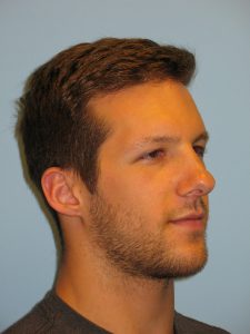 Patient 4 After Otoplasty Right Side