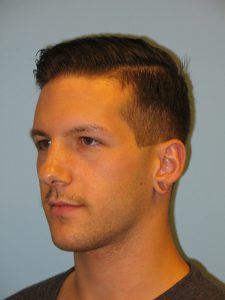 Patient 4 Before Otoplasty Left Side