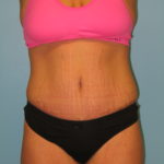 Patient 9 After Abdominoplasty Front View1