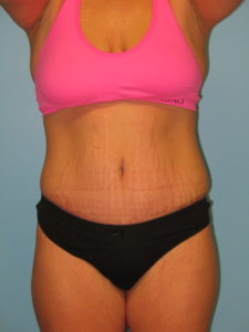 Patient 9 After Abdominoplasty Front View1