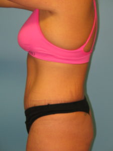 Patient 9 After Abdominoplasty Side View