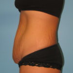 Patient 9 Before Abdominoplasty Side View