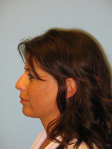 Patient 1 Before Rhinoplasty Left Side View
