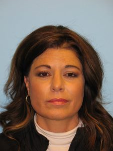 Patient 1 After Rhinoplasty Front View