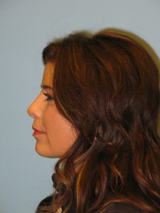 Patient 1 After Rhinoplasty Left Side View