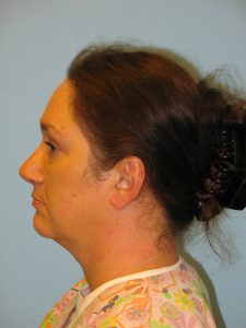 Patient 2 After Rhinoplasty Left Side View