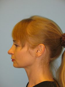 Patient 3 Before Rhinoplasty Left Side View Copy