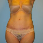 Patient 1 After Tummy Tuck Front View