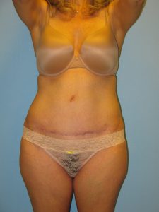 Patient 1 After Tummy Tuck Front View