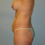 Patient 1 Before Tummy Tuck Left Side View