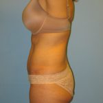 Patient 1 After Tummy Tuck Left Side View