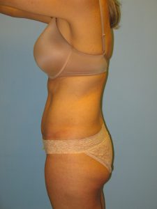 Patient 1 After Tummy Tuck Left Side View