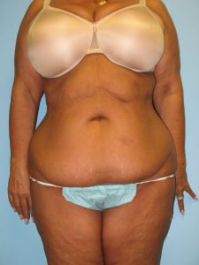 Patient 2 Before Tummy Tuck Front View