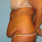 Patient 2 Before Tummy Tuck Left Side View