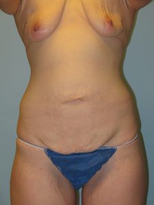 Patient 3 Before Abdominoplasty Front View