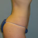 Patient 3 Before Abdominoplasty Right Side View