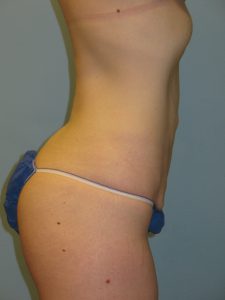 Patient 3 Before Abdominoplasty Right Side View