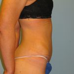Patient 3 After Abdominoplasty Right Side View