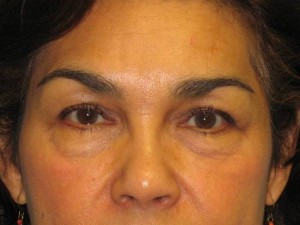 Patient Before Blepharoplasty Photo