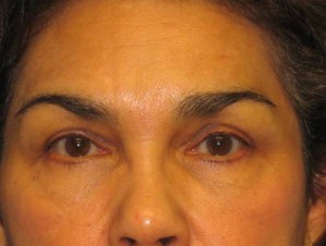 Patient After Blepharoplasty Photo