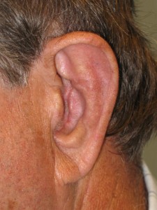 Patient With Light Brown Hair Before Otoplasty