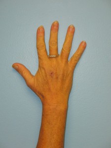 Hand With Lesion Before Reconstruction