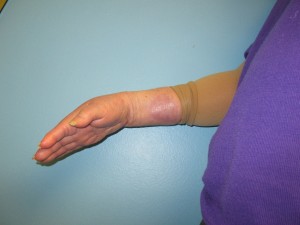 Arm With Lesion Removed