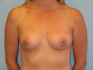 Patient A Before Breast Augmentation Front View