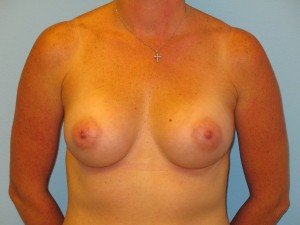 Patient A After Breast Augmentation Front View