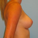 Patient A After Breast Augmentation Right View