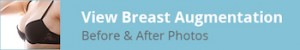 Breast Augmentation Before and After Photos Title Image