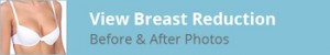 Breast Reduction Before and After Photos Title Image