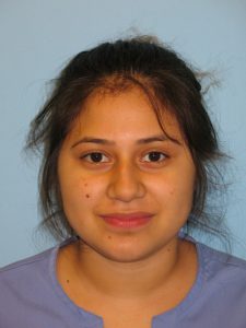 Patient 7 Before Rhinoplasty Front View