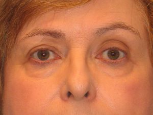 Patient 12 Before Blepharoplasty