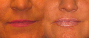 Before and After Surgical Lip Enhancement Interior Image